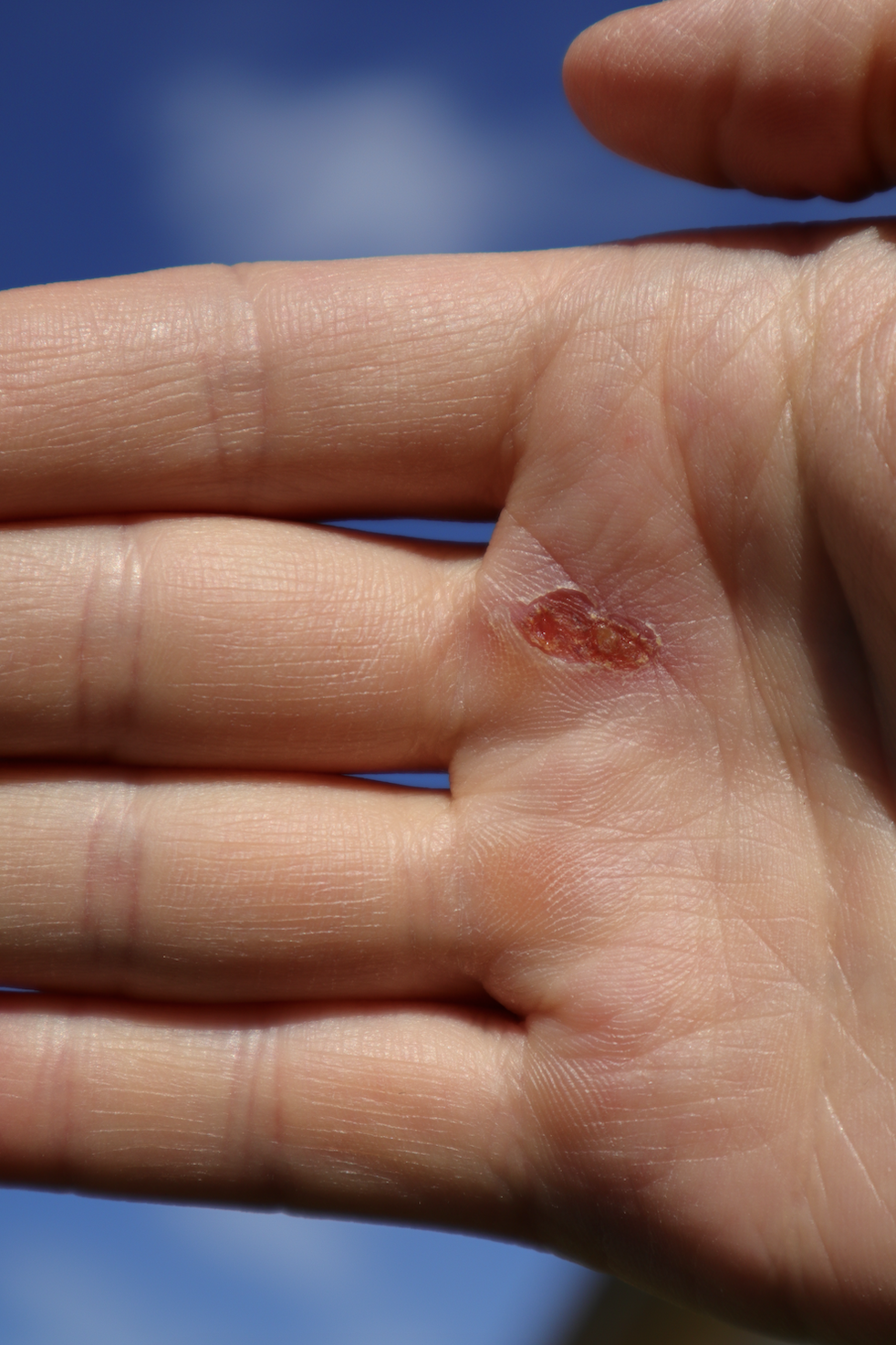 Small hand laceration